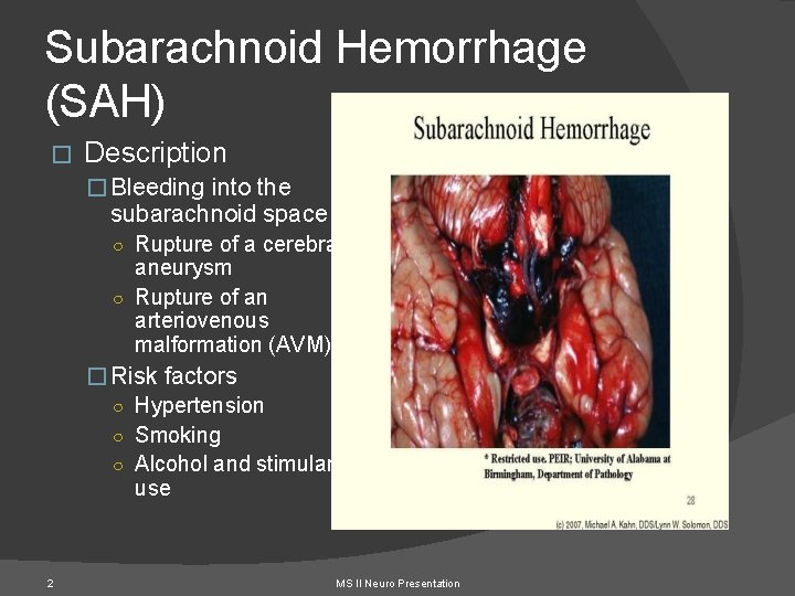 Subarachnoid Hemorrhage (SAH) � Description � Bleeding into the subarachnoid space ○ Rupture of