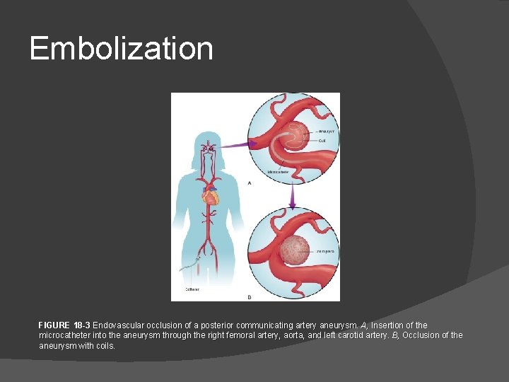 Embolization FIGURE 18 -3 Endovascular occlusion of a posterior communicating artery aneurysm. A, Insertion