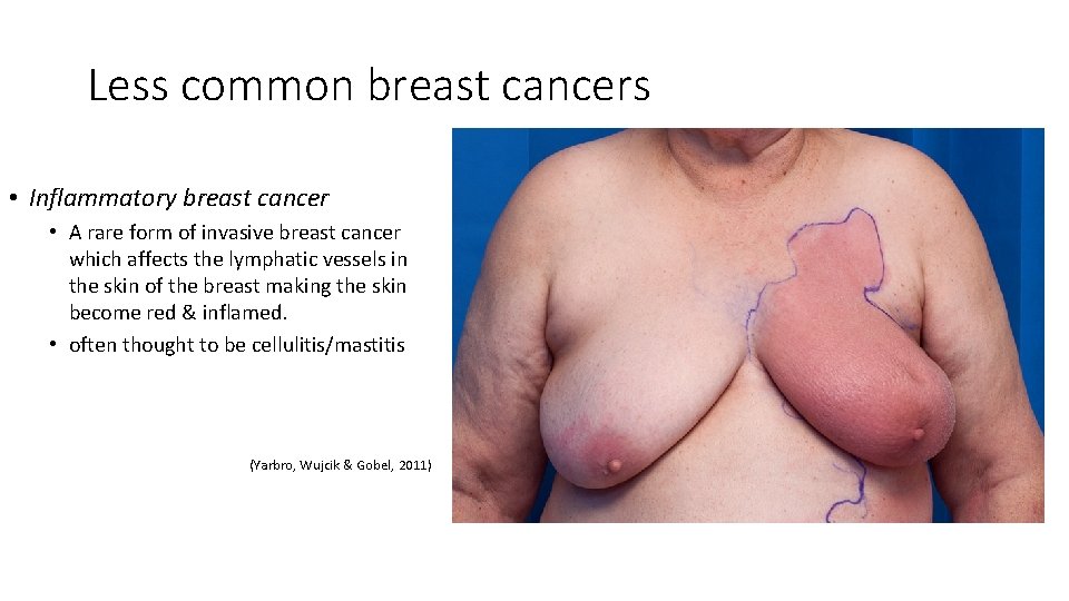 Less common breast cancers • Inflammatory breast cancer • A rare form of invasive