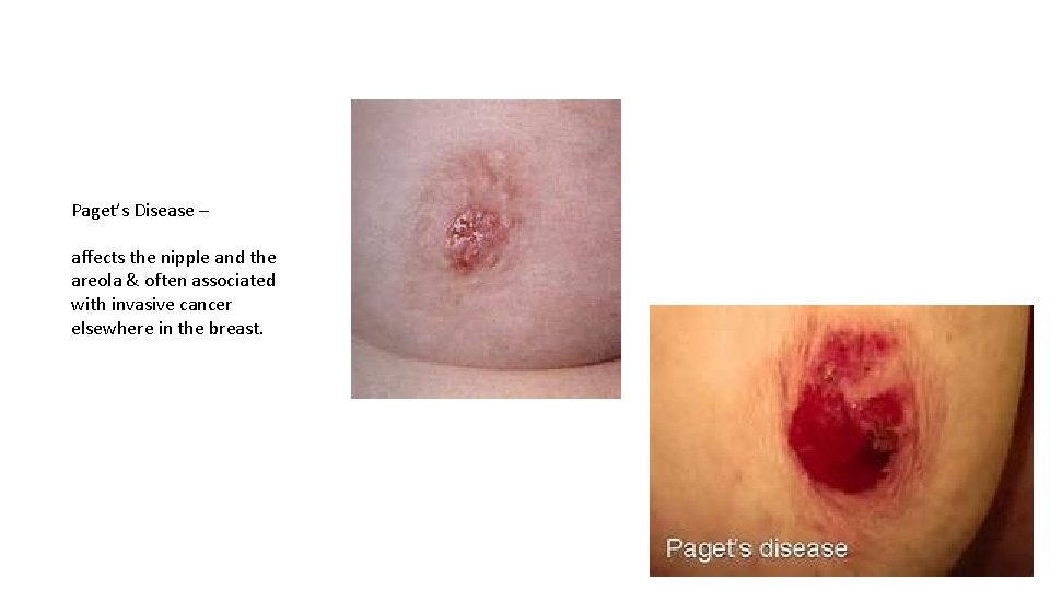 Paget’s Disease – affects the nipple and the areola & often associated with invasive