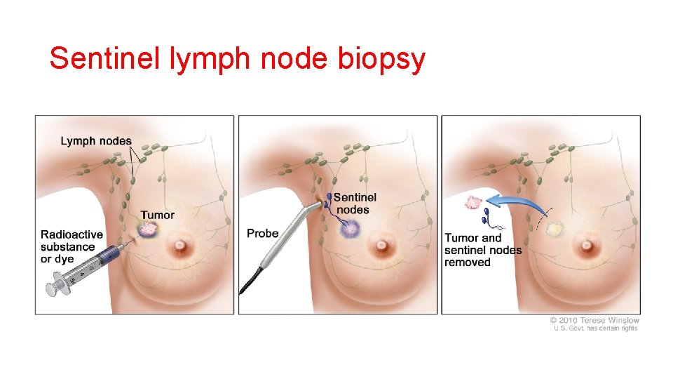 Sentinel lymph node biopsy 