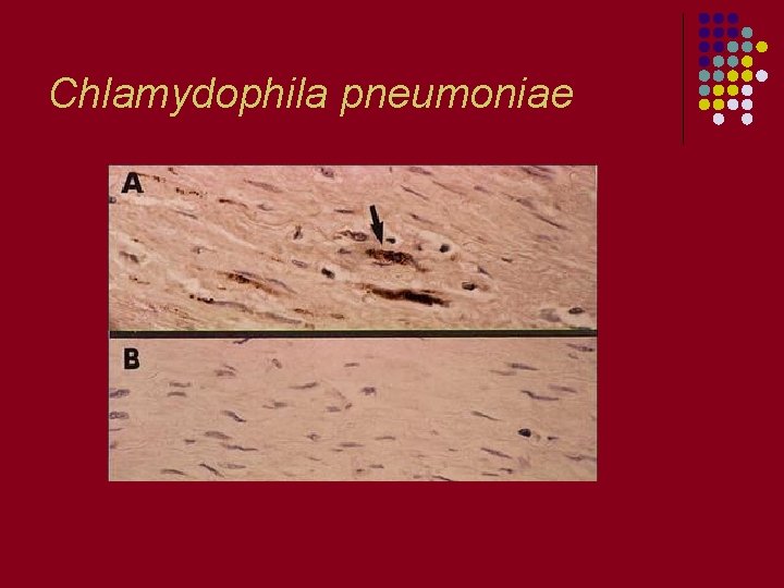 Chlamydophila pneumoniae 