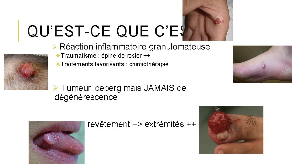 QU’EST-CE QUE C’EST ? Ø Réaction inflammatoire granulomateuse Traumatisme : épine de rosier ++