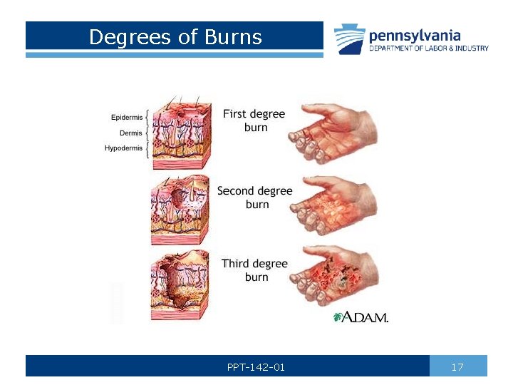 Degrees of Burns PPT-142 -01 17 