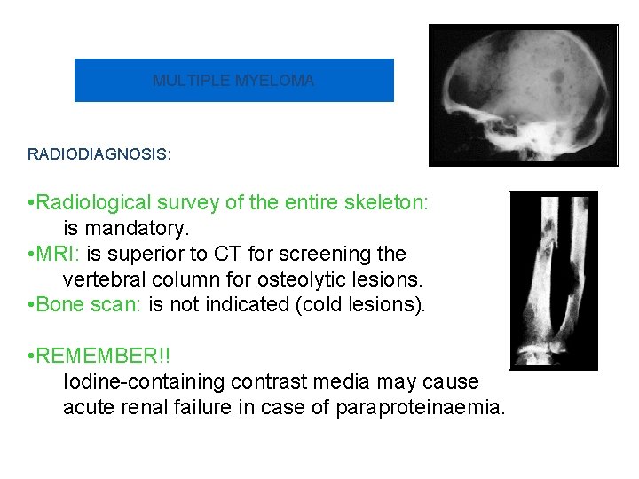 MULTIPLE MYELOMA RADIODIAGNOSIS: • Radiological survey of the entire skeleton: is mandatory. • MRI: