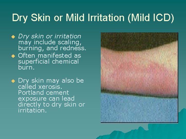 Dry Skin or Mild Irritation (Mild ICD) u u u Dry skin or irritation