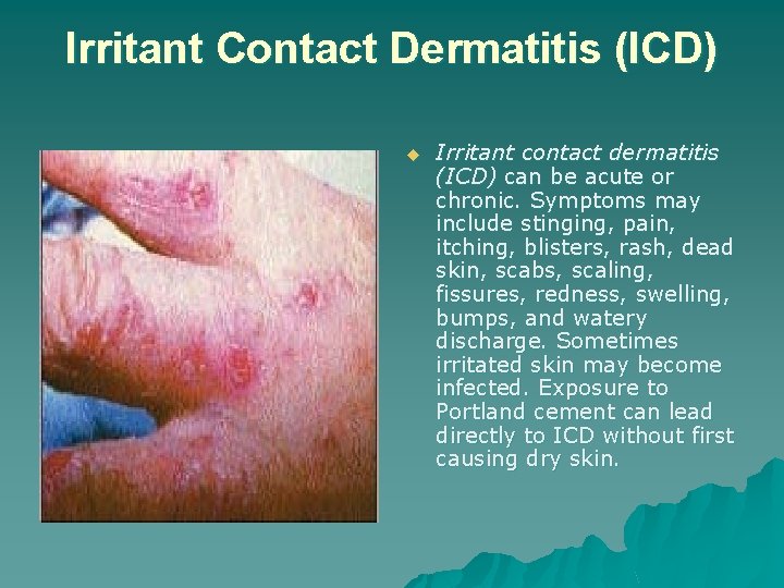 Irritant Contact Dermatitis (ICD) u Irritant contact dermatitis (ICD) can be acute or chronic.