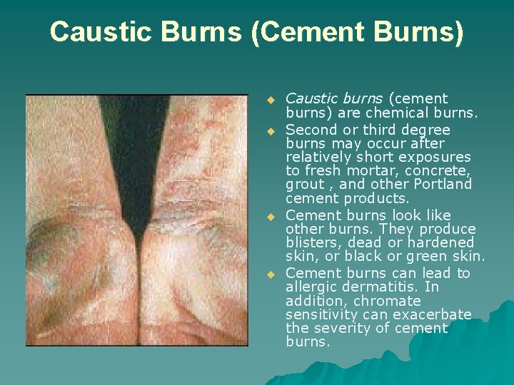 Caustic Burns (Cement Burns) u u Caustic burns (cement burns) are chemical burns. Second