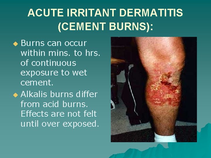 ACUTE IRRITANT DERMATITIS (CEMENT BURNS): Burns can occur within mins. to hrs. of continuous