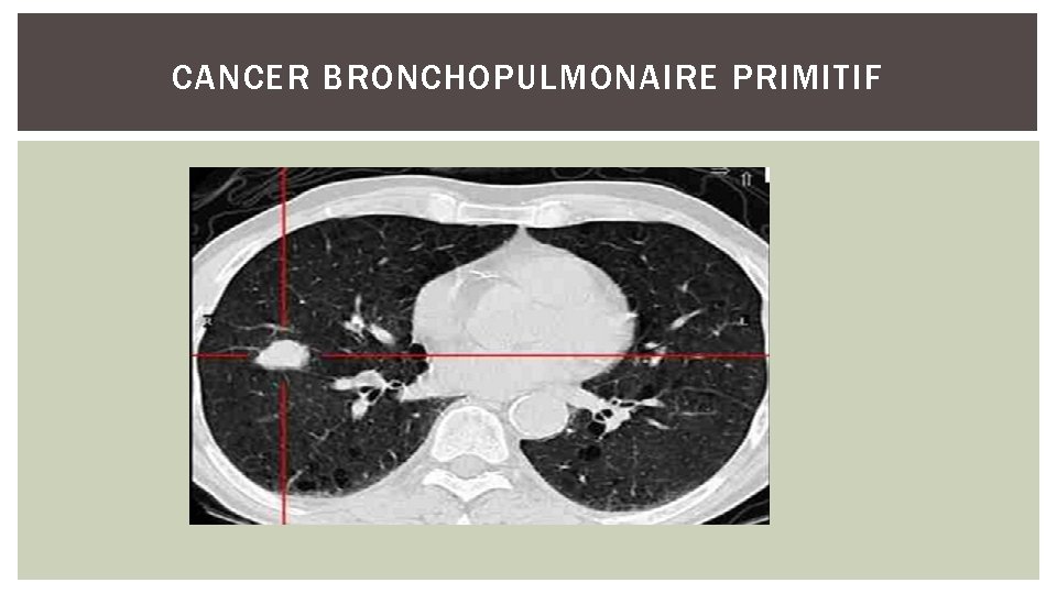CANCER BRONCHOPULMONAIRE PRIMITIF 