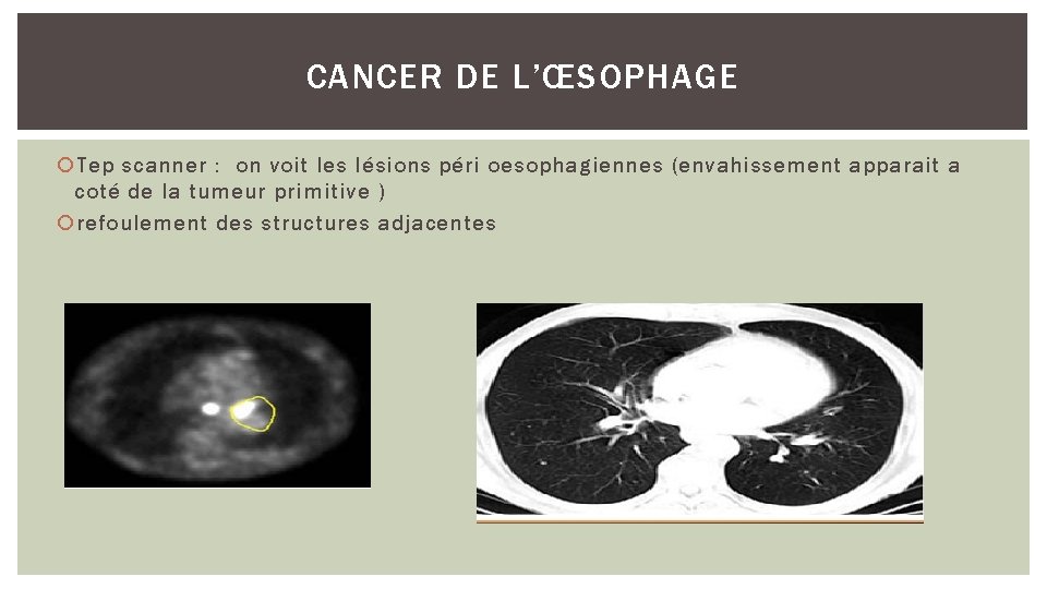 CANCER DE L’ŒSOPHAGE Tep scanner : on voit les lésions péri oesophagiennes (envahissement apparait