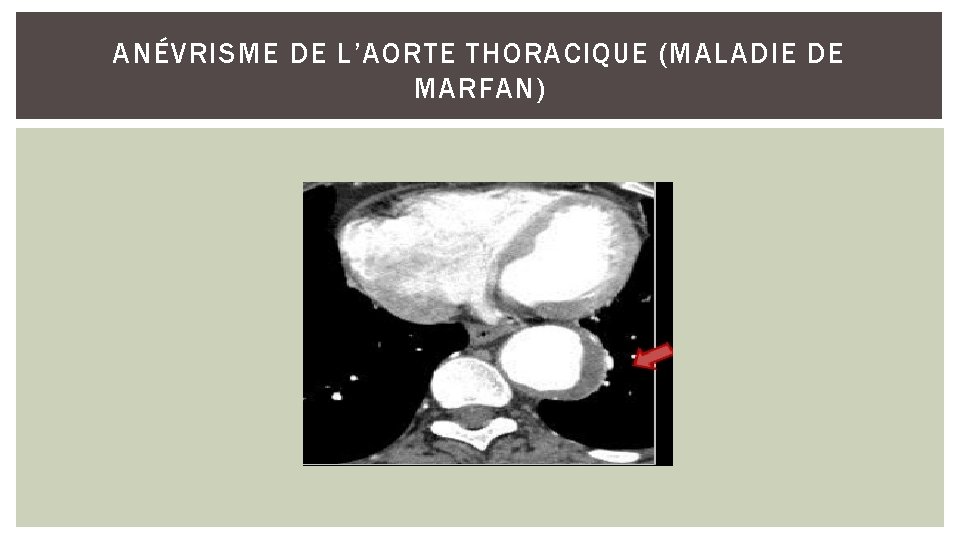 ANÉVRISME DE L’AORTE THORACIQUE (MALADIE DE MARFAN) 