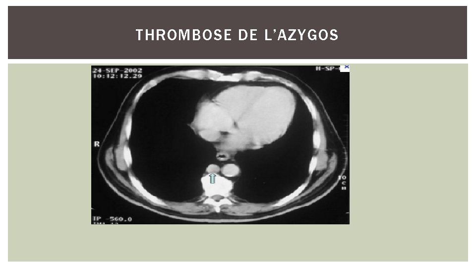 THROMBOSE DE L’AZYGOS 