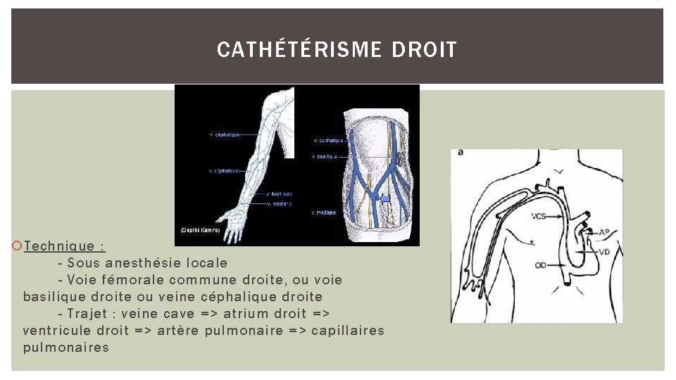 CATHÉTÉRISME DROIT Technique : - Sous anesthésie locale - Voie fémorale commune droite, ou