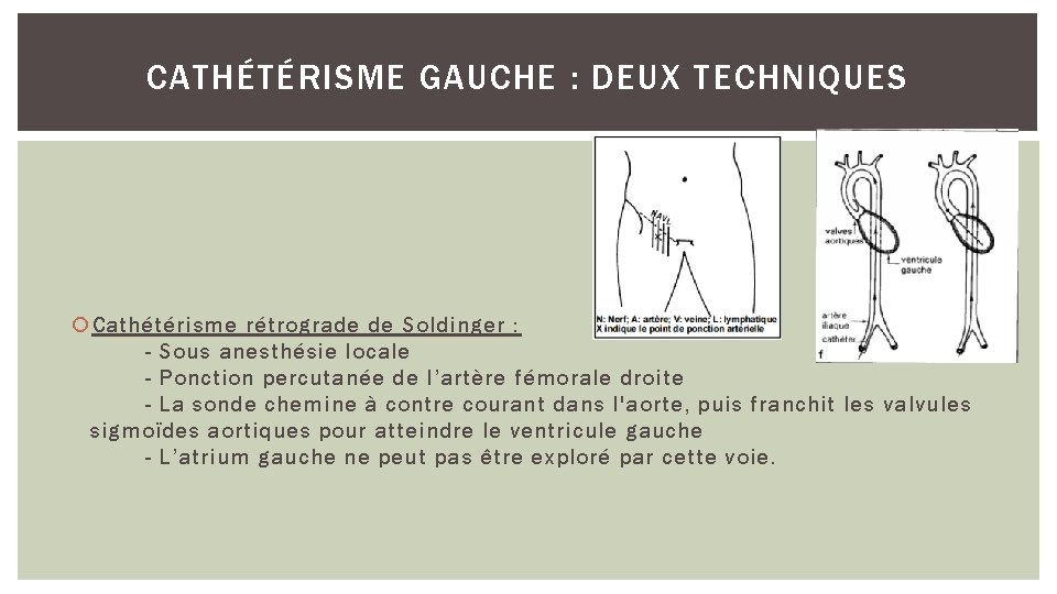 CATHÉTÉRISME GAUCHE : DEUX TECHNIQUES Cathétérisme rétrograde de Soldinger : - Sous anesthésie locale