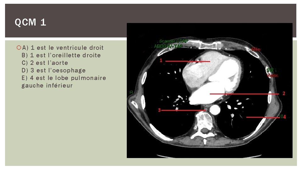 QCM 1 A) 1 est le ventricule droit B) 1 est l’oreillette droite C)