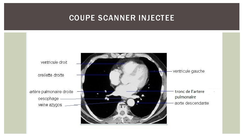 COUPE SCANNER INJECTEE 