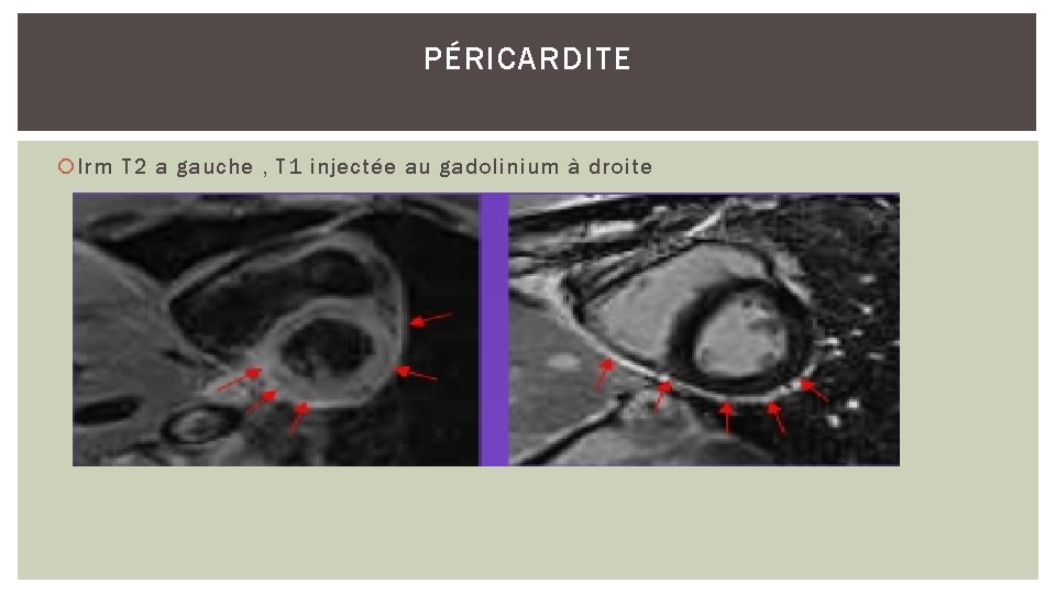 PÉRICARDITE Irm T 2 a gauche , T 1 injectée au gadolinium à droite