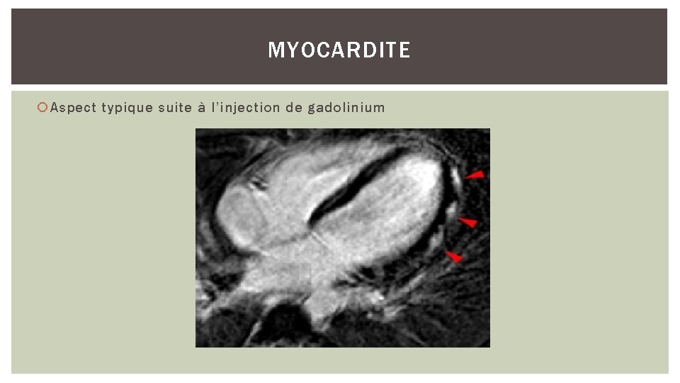 MYOCARDITE Aspect typique suite à l’injection de gadolinium 