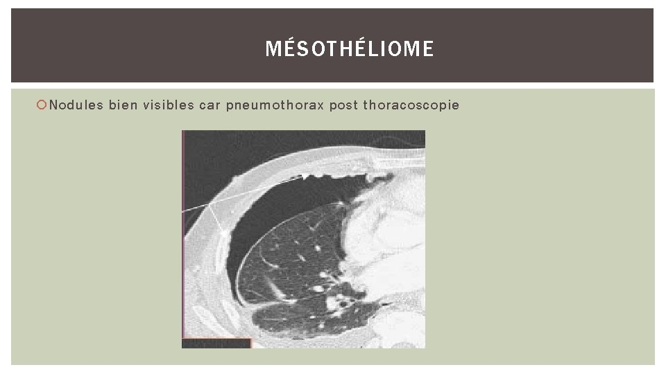 MÉSOTHÉLIOME Nodules bien visibles car pneumothorax post thoracoscopie 