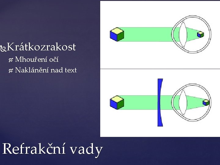 Krátkozrakost Mhouření očí Naklánění nad text Refrakční vady 