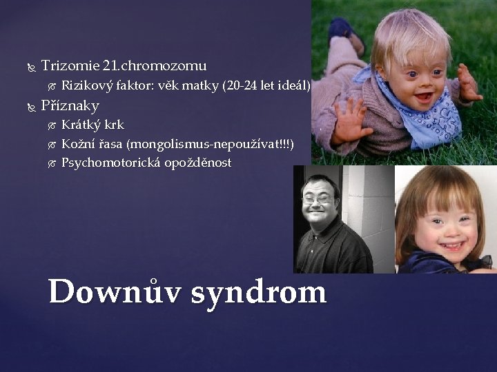  Trizomie 21. chromozomu Rizikový faktor: věk matky (20 -24 let ideál) Příznaky Krátký