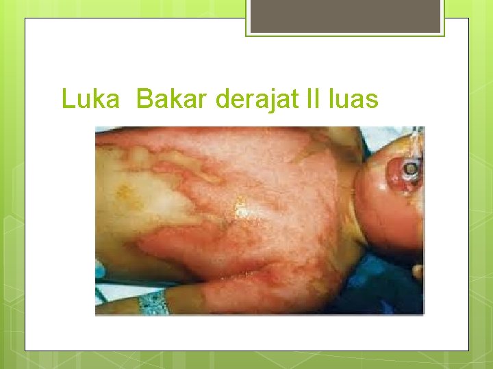 Luka Bakar derajat II luas 