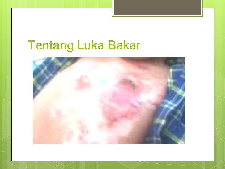 Tentang Luka Bakar 