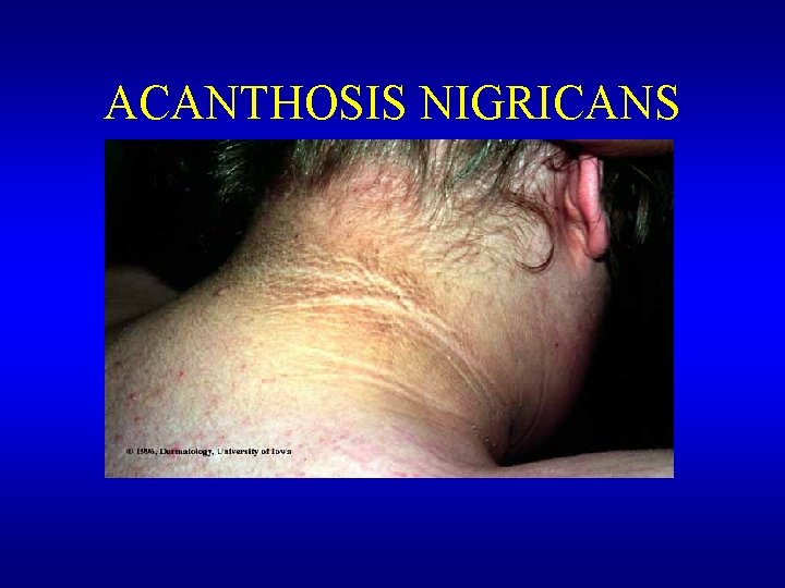 ACANTHOSIS NIGRICANS 