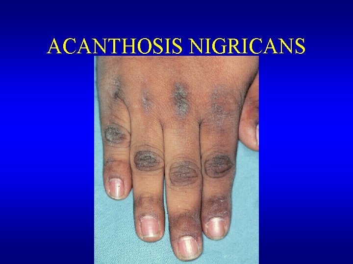 ACANTHOSIS NIGRICANS 