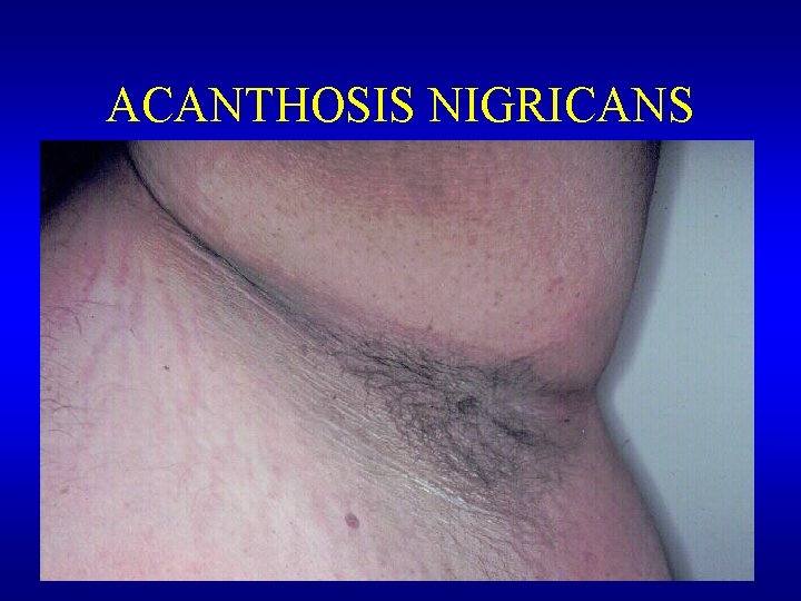 ACANTHOSIS NIGRICANS 