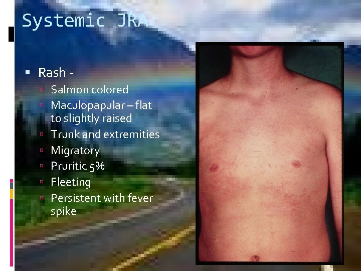 Systemic JRA Rash Salmon colored Maculopapular – flat to slightly raised Trunk and extremities