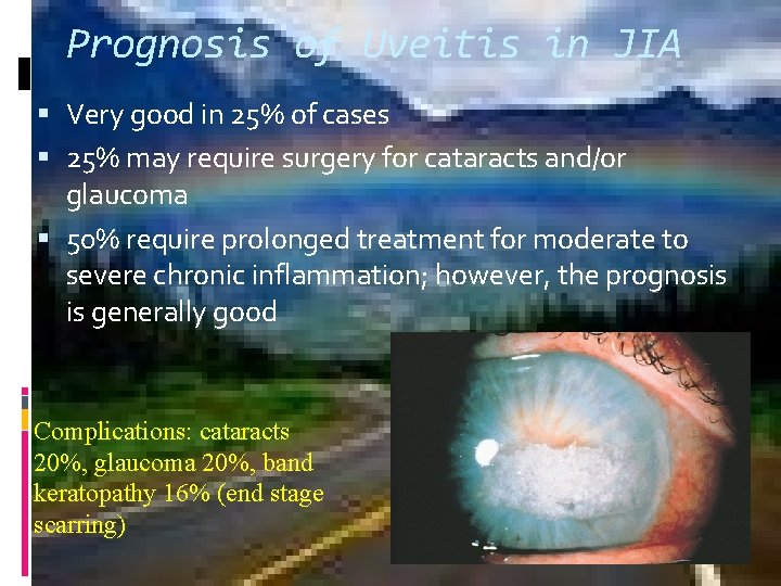 Prognosis of Uveitis in JIA Very good in 25% of cases 25% may require