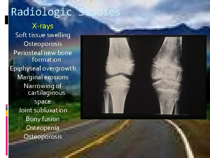 Radiologic Studies X-rays Soft tissue swelling Osteoporosis Periosteal new bone formation Epiphyseal overgrowth Marginal