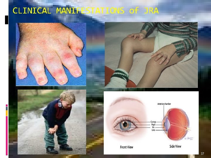CLINICAL MANIFESTATIONS of JRA 37 