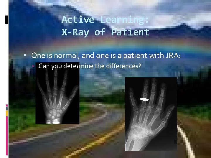 Active Learning: X-Ray of Patient One is normal, and one is a patient with