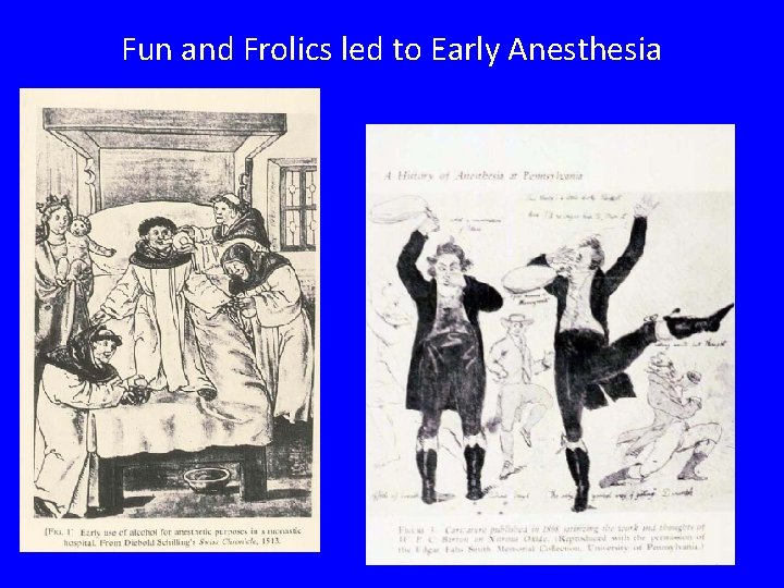 Fun and Frolics led to Early Anesthesia 