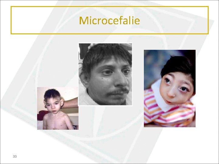 Microcefalie 33 