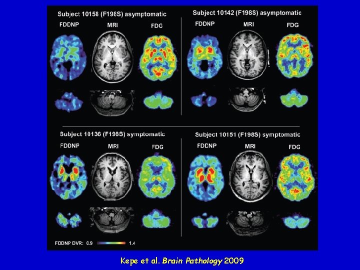Kepe et al. Brain Pathology 2009 