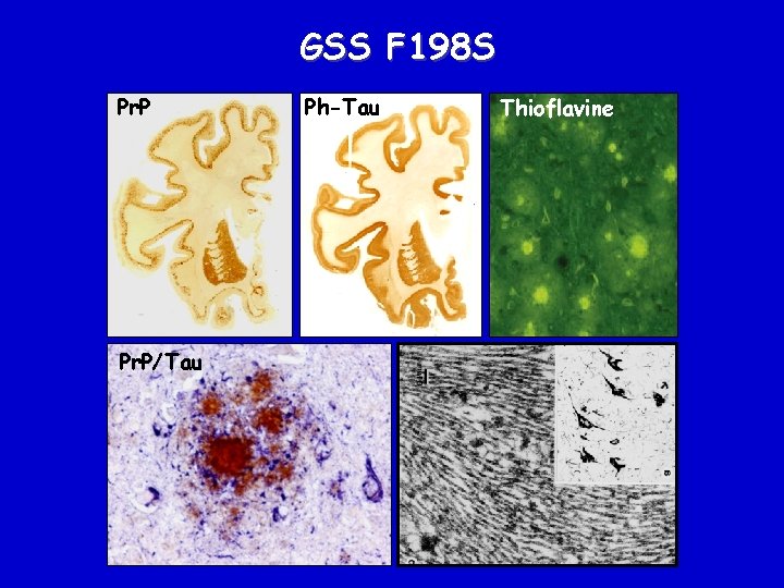 GSS F 198 S Pr. P/Tau Ph-Tau Thioflavine 