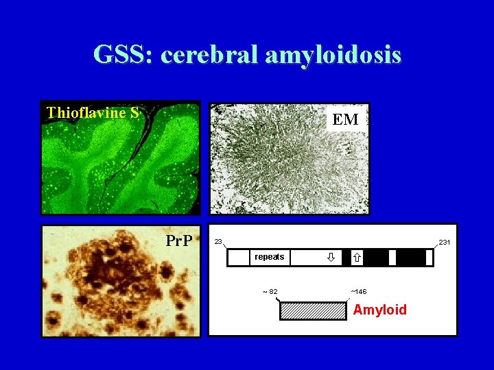 GSS: cerebral amyloidosis Thioflavine S EM Pr. P 23 231 repeats ~ 82 ~146