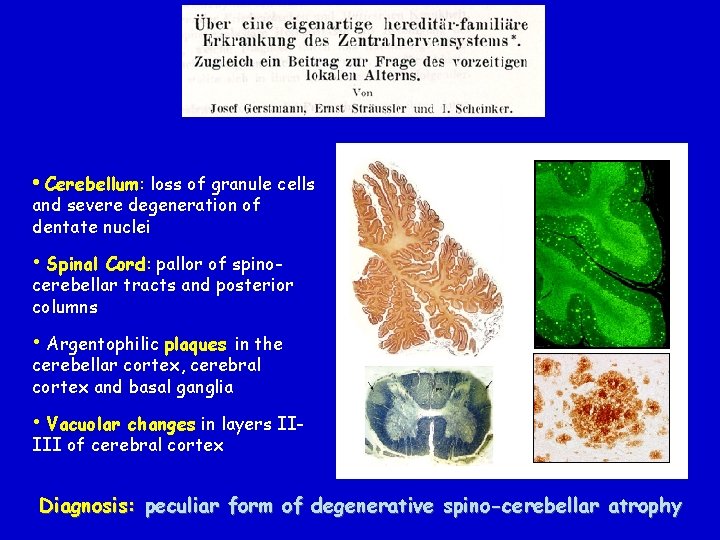  • Cerebellum: loss of granule cells and severe degeneration of dentate nuclei •