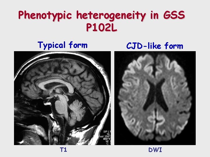 Phenotypic heterogeneity in GSS P 102 L Typical form CJD-like form T 1 DWI