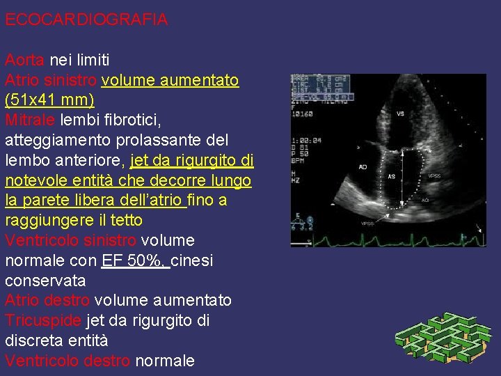 ECOCARDIOGRAFIA Aorta nei limiti Atrio sinistro volume aumentato (51 x 41 mm) Mitrale lembi