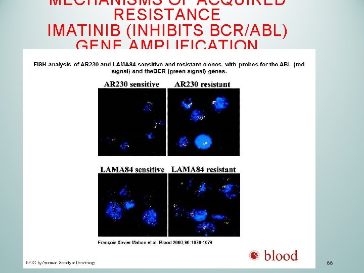 MECHANISMS OF ACQUIRED RESISTANCE IMATINIB (INHIBITS BCR/ABL) GENE AMPLIFICATION 66 