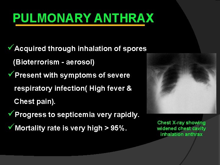 PULMONARY ANTHRAX üAcquired through inhalation of spores (Bioterrorism - aerosol) üPresent with symptoms of