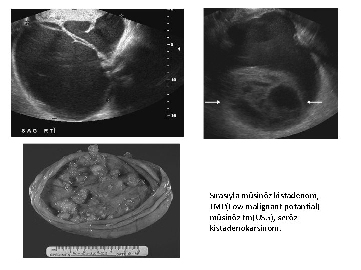 Sırasıyla müsinöz kistadenom, LMP(Low malignant potantial) müsinöz tm(USG), seröz kistadenokarsinom. 