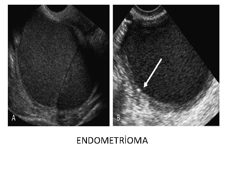 ENDOMETRİOMA 