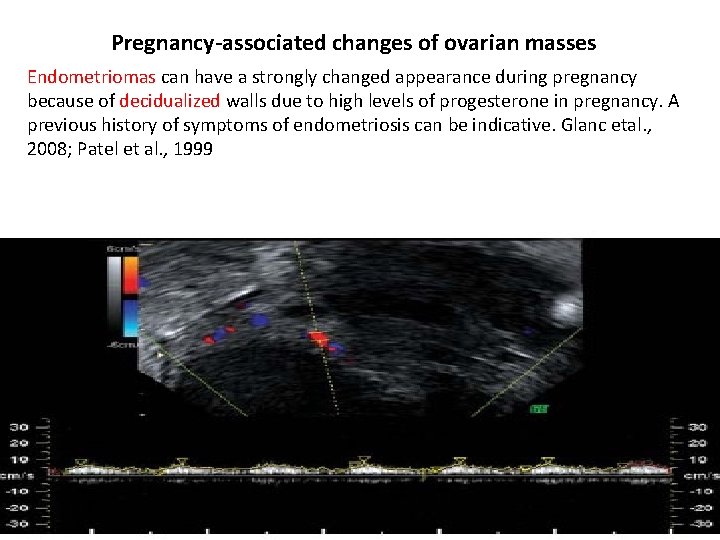 Pregnancy-associated changes of ovarian masses Endometriomas can have a strongly changed appearance during pregnancy