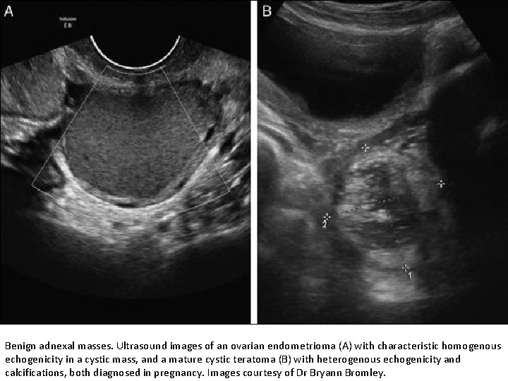 Benign adnexal masses. Ultrasound images of an ovarian endometrioma (A) with characteristic homogenous echogenicity